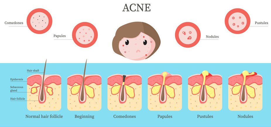 acne_foodhyme
